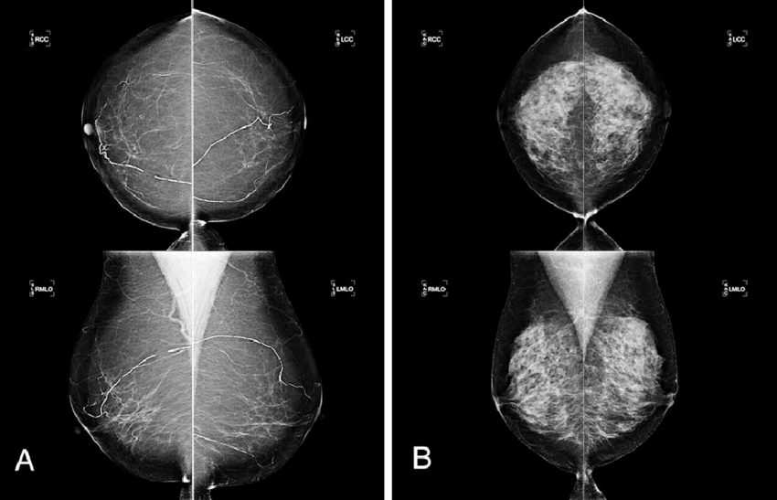 Mammographic Image Analysis and Classification Web-app